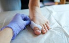 Hallux valgus