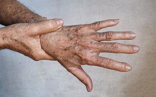 Melanin im Überfluss - Hyperpigmentierung und was man dagegen tun kann